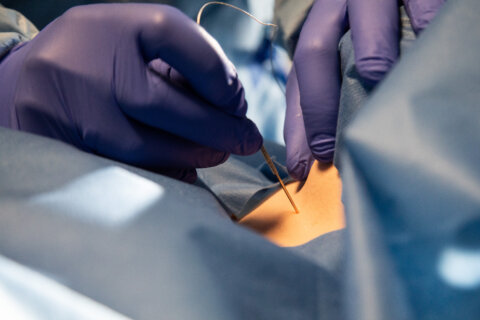Surgical needle entering skin - tracheostomy